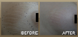 Animated graphic of Skinpeccable treatment process