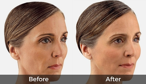 before-after botox in cheekbones