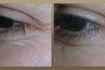 botox west hollywood