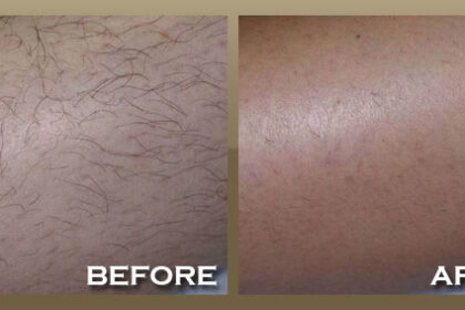 Laser Hair Removal for Legs