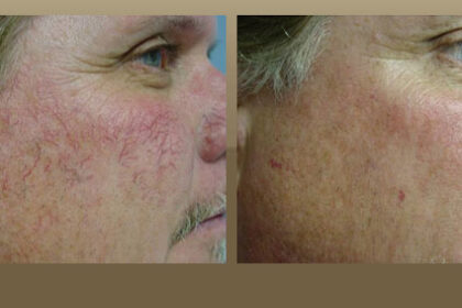acne scar treatment los angeles