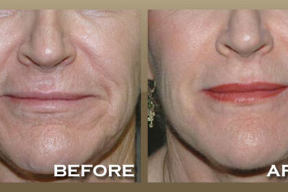 Radiesse Treatment