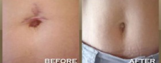 Stretch mark removal with laser treatment results