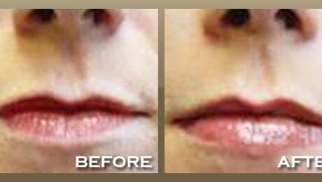 Close-up comparison of lips in two images labeled Before and After. The left image shows the lips with a smoother texture, while the right image reveals fuller lips with more defined contours.