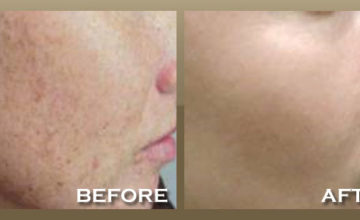 Treatmement For Red or Brown Spots