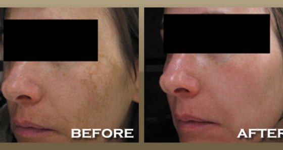 Melasma Before and After Photo