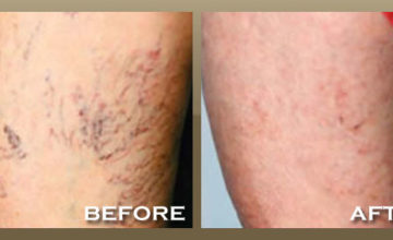 Sclerotherapy For Vein Removal