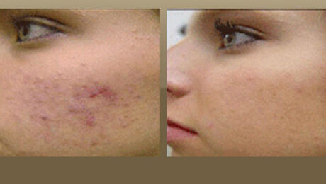 acne scar treatment los angeles