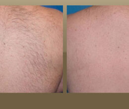 laser hair removal Las Angeles