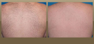 laser hair removal Las Angeles