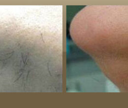 laser hair removal west hollywood