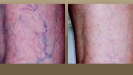 vein treatment