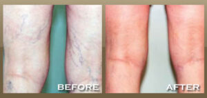 Varicose veins before and after treatment results.