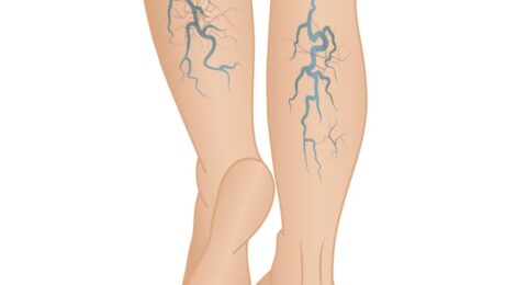 Varicose Veins