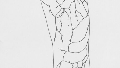 Varicose Veins