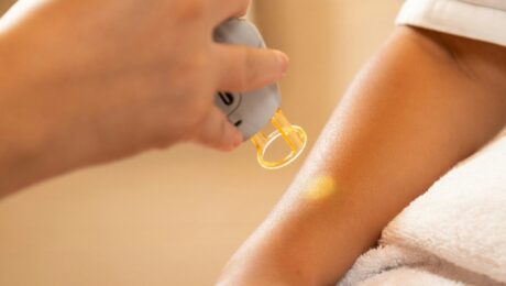 Laser Hair Removal