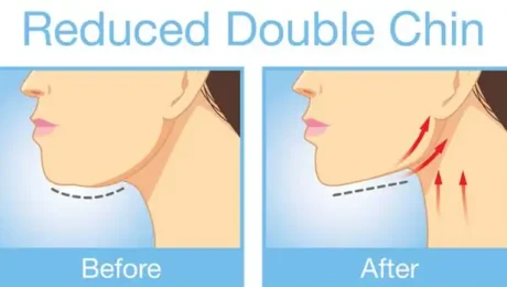 Kybella