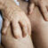 Varicose Veins