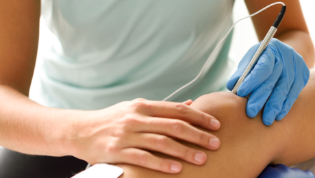 varicose vein treatments
