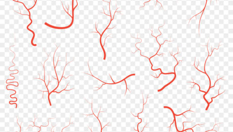Vein Issues