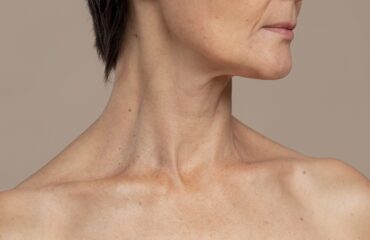CoolSculpting and Kybella