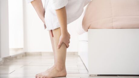 Varicose Veins