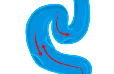 Varicose Veins