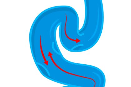 Varicose Veins