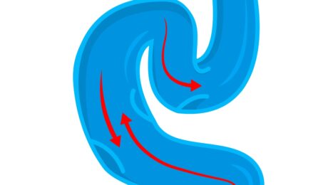 Varicose Veins