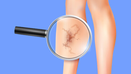 Varicose veins