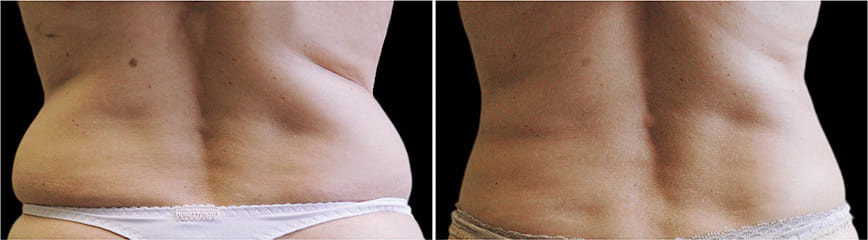Before and After
