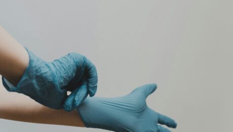 Varicose Veins