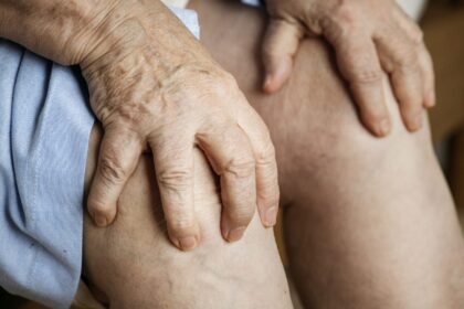 Varicose Veins