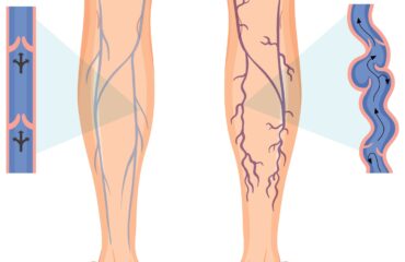 Vein Treatment