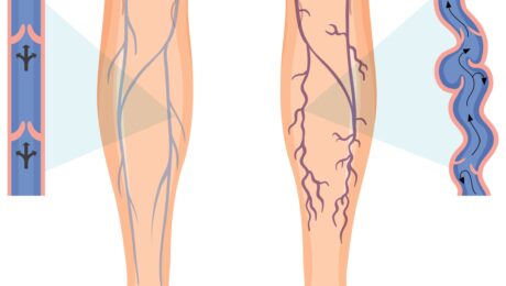 Vein Treatment
