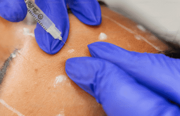 Dermal-Fillers Dermal Fillers