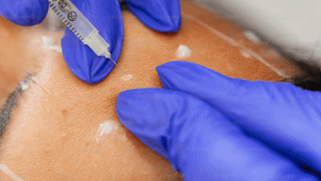 Dermal-Fillers Dermal Fillers