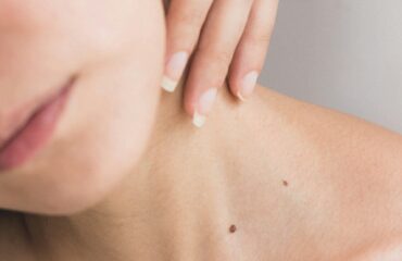 Chronic Skin