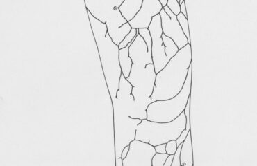 Varicose Veins