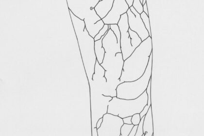 Varicose Veins