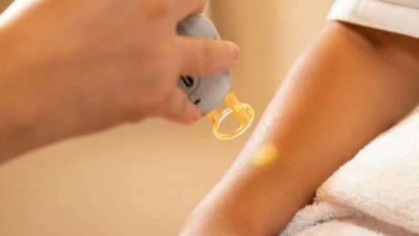 Laser Hair Removal