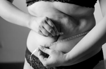 CoolSculpting