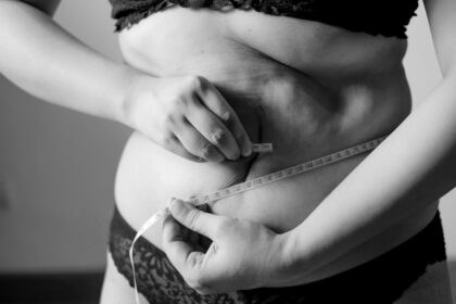 CoolSculpting