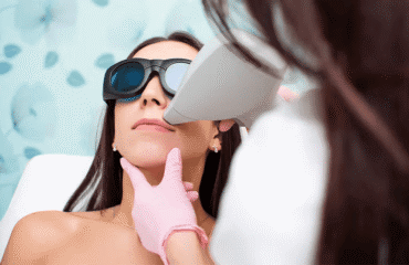 laser hair removal