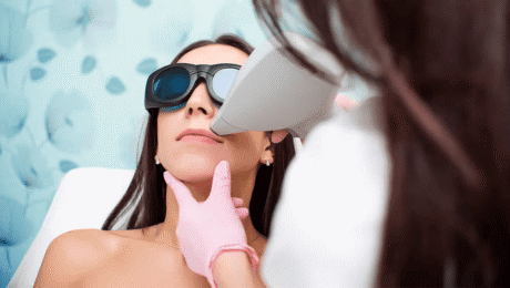 laser hair removal