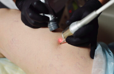 Vascular Laser Treatment Vascular Laser Treatment