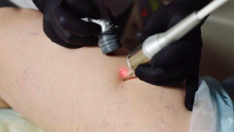 Vascular Laser Treatment Vascular Laser Treatment